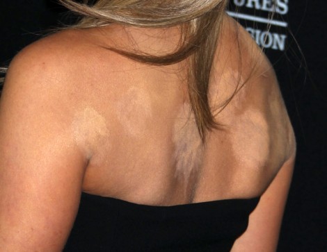 Jennifer Aniston Cupping For Fertility As Wedding Delayed, Is Baby A Deal Breaker? 0424