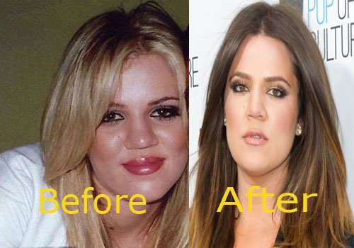 Khloe Kardashian's Nose Job No Longer A Plastic Surgery Secret (PHOTOS)