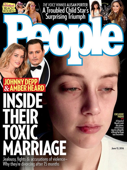 Amber Heard Releases New Photos Allegedly Showing Johnny Depp Violence: Nasty $400 Million Divorce
