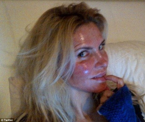 Brandi Glanville Burns Face With Laser Peel Cosmetic Surgery (Photo) 0411