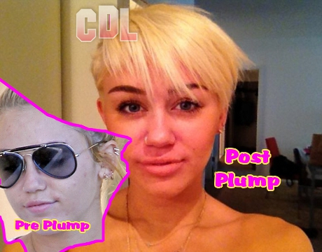 Miley Cyrus Plumps her Lips up Big Time -- Next Stop Plastic Surgery?